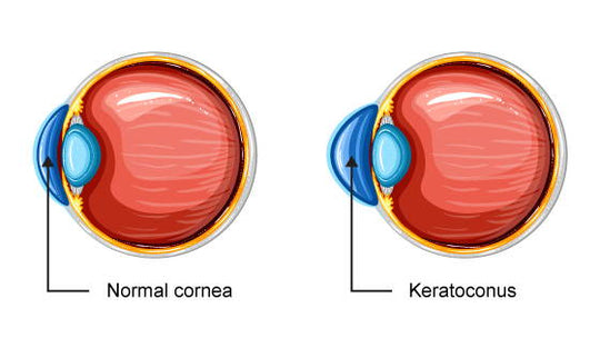 Keratoconus And Contact Lenses | Diagnosis, Cure & Complications